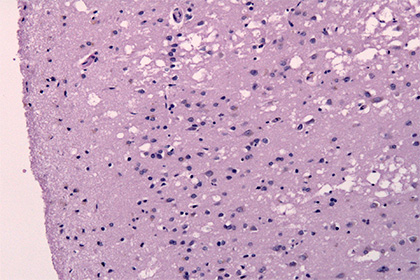 Впервые выявлены случаи заражения болезнью Альцгеймера