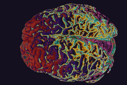 Бессонница оказалась связана с нарушением структуры мозга