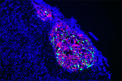 Обнаружен эффективный способ борьбы с раком мозга