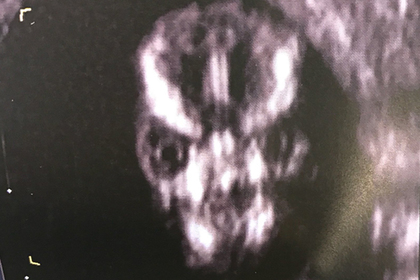 Нерожденный ребенок с лицом Волан-де-Морта напугал мать и ужаснул соцсети