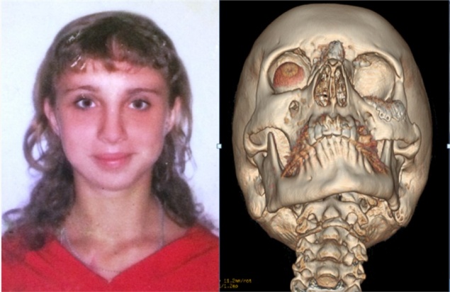 «Вместо лица была кровавая каша»: красноярке спустя 10 лет после ДТП восстановили лицо