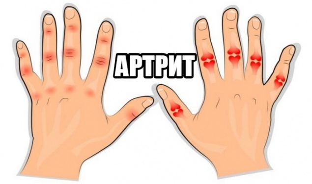 АРТРИТ