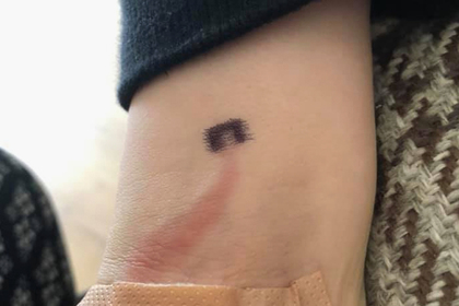 Мать заметила ссадину на руке сына и спасла ему жизнь