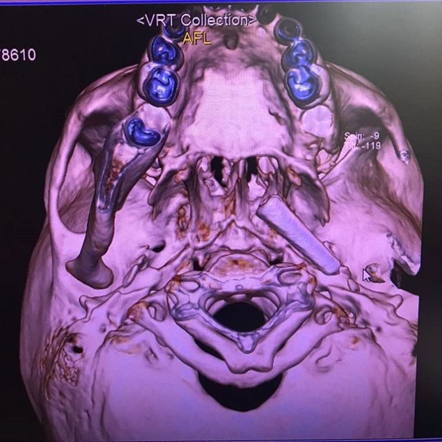 Врачи достали из головы маленькой жительницы Кемерово часть кисти для рисования. Она была там полгода