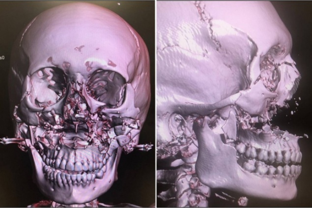 Хирурги БСМП по крупицам собрали раздробленное при аварии лицо девушки