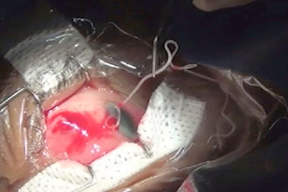 Укушенный собакой мужчина годами ходил с живым червем в глазу