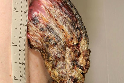 Мужчина три года отращивал на спине 14-сантиметровый рог