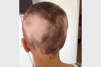 Женщина перепутала облысение с беременностью