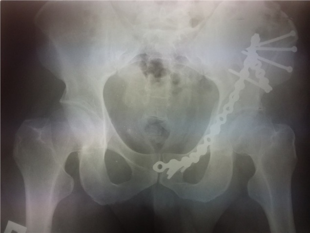 «Сопоставимо с травмами в ДТП»: травматологи красноярской БСМП показали последствия катания на «плюшке»