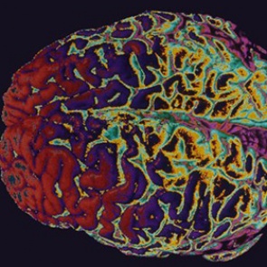 Бессонница оказалась связана с нарушением структуры мозга