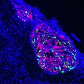 Обнаружен эффективный способ борьбы с раком мозга