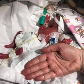 500-граммовая малышка размером с ладонь пошла на поправку и прибавила в весе