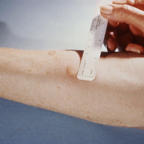 «Мочите, но не трите!»: Минздрав развеял миф о пробе манту