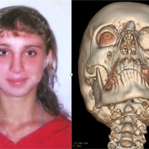 «Вместо лица была кровавая каша»: красноярке спустя 10 лет после ДТП восстановили лицо