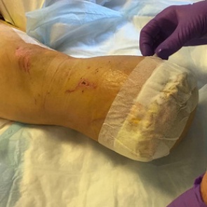 Американец пожарил свою ногу и накормил ей друзей