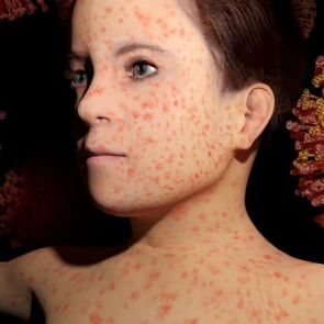 Вспышка кори коснется россиян из-за отсутствия плановой вакцинации