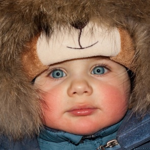 АЛЛЕРГИЯ НА ХОЛОД