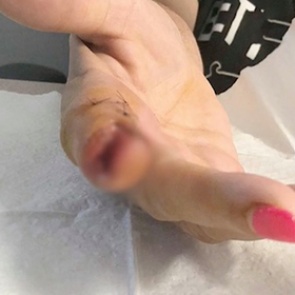 Девушка посетила маникюрный салон и лишилась фаланги пальца