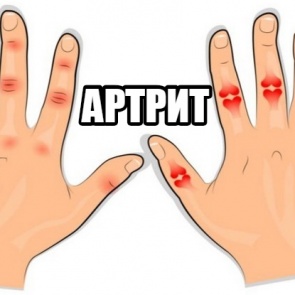 АРТРИТ