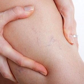 СЕМЬ УПРАЖНЕНИЙ ОТ ВАРИКОЗА