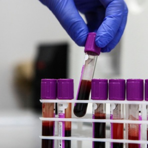 Названы регионы России с выросшей заболеваемостью ВИЧ