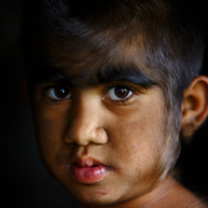 Редкое заболевание сделало детей похожими на оборотней