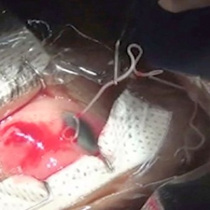 Укушенный собакой мужчина годами ходил с живым червем в глазу