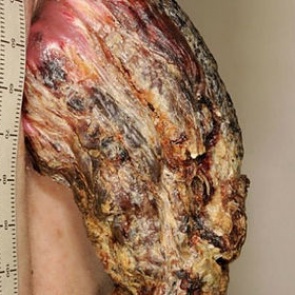 Мужчина три года отращивал на спине 14-сантиметровый рог