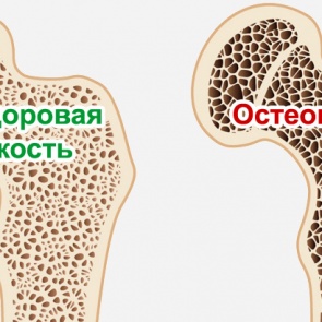 Ачинцев приглашают в Школу по борьбе с остеопорозом