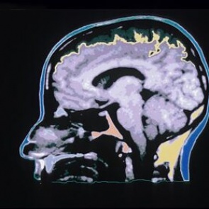 Ученые обнаружили указывающие на признаки рака «горячие точки» в мозгу