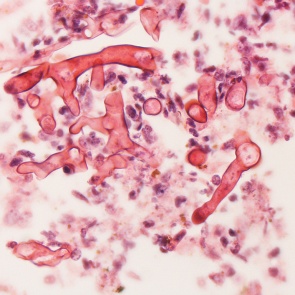 Мукормикоз: смертельное осложнение после COVID